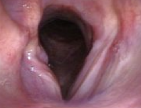 Paralysie Larynx Chien